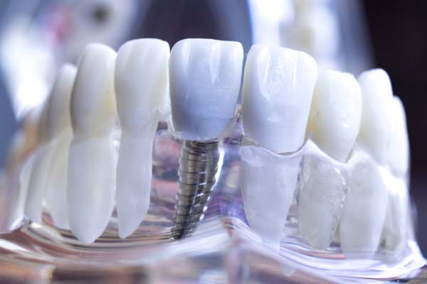 Tooth Replacement: Dentures Or Dental Implants?