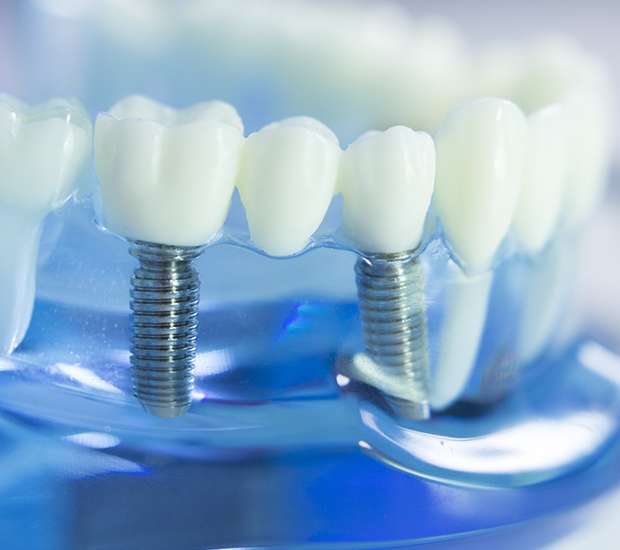 Pasadena Dental Implants